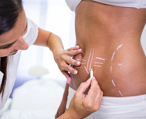 coolSculpting liverpool