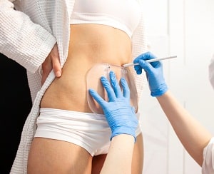 Fat Freezing Liverpool at Royal Liver Building