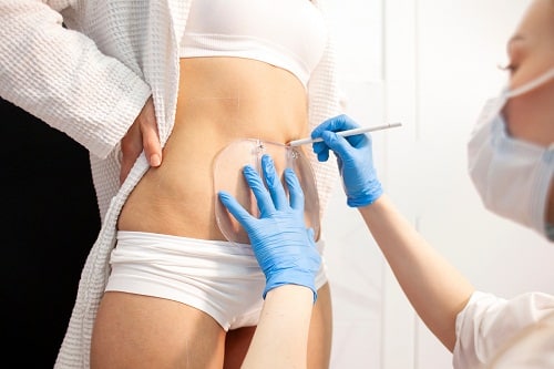 Fat Freezing Results CoolSculpting Clinic UK Fat Freezing Liverpool