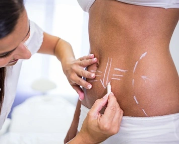 CoolSculpting Liverpool