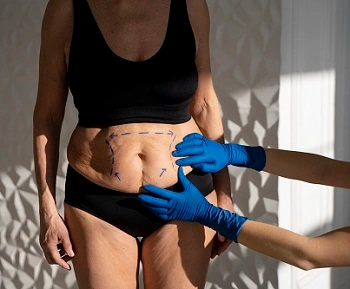 CoolSculpting Liverpool