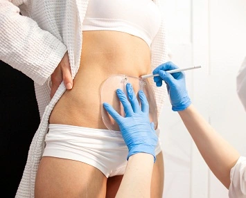 fat freezing Liverpool at Royal Liver Building